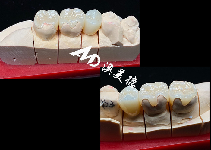 Inlays cerâmicos OEM de precisão para restaurações dentárias duráveis e de aparência natural com resistência e confiabilidade superiores