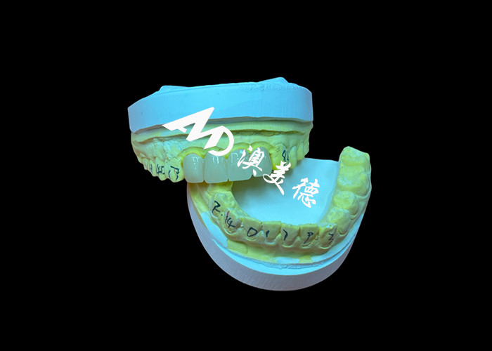 Restauração dentária Coroa dentária de zircônia translúcida para ajuste preciso e estética natural