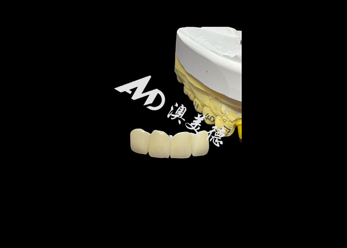 Restauração dentária Coroa dentária de zircônia translúcida para ajuste preciso e estética natural