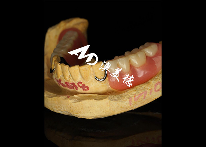 Dentadura removível com estrutura de metal fundido para superior força e estabilidade com conforto duradouro