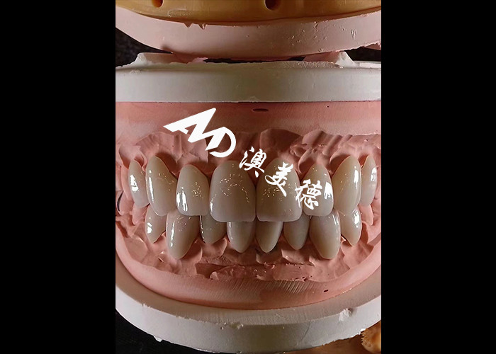 Dentologia Cosmética EMAX Veneers Dentários 0,3-0,5 mm de espessura para restaurações estéticas