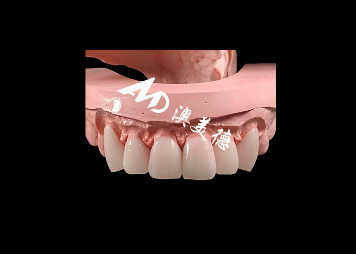 Dentologia Cosmética EMAX Veneers Dentários 0,3-0,5 mm de espessura para restaurações estéticas