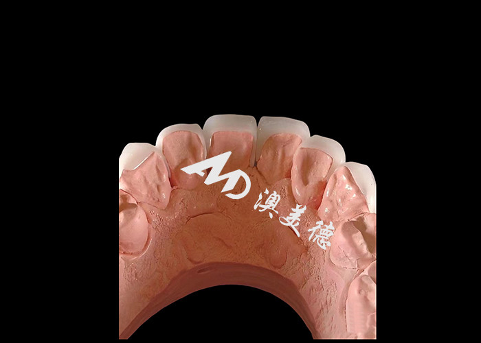 Dentologia Cosmética EMAX Veneers Dentários 0,3-0,5 mm de espessura para restaurações estéticas