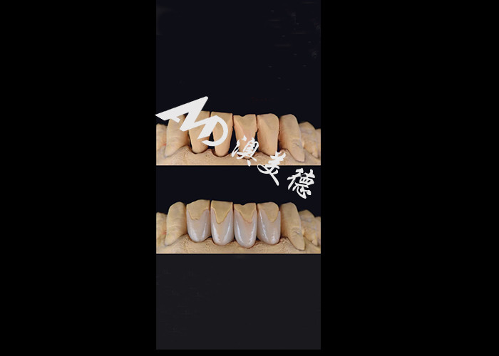0.3-0.5mm Ultra fina IPS EMAX Veneers de porcelana para Estética Smile Makeovers