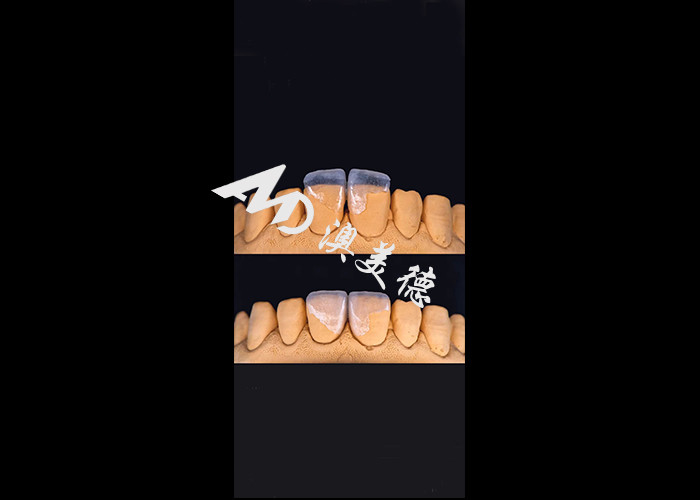 0.3-0.5mm Ultra fina IPS EMAX Veneers de porcelana para Estética Smile Makeovers
