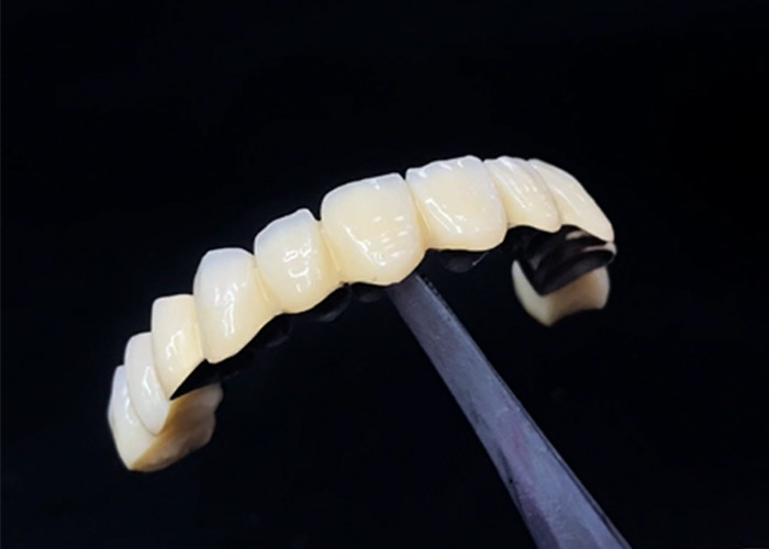Porcelana fundida com coroa de metal que combina durabilidade e beleza para a saúde dentária
