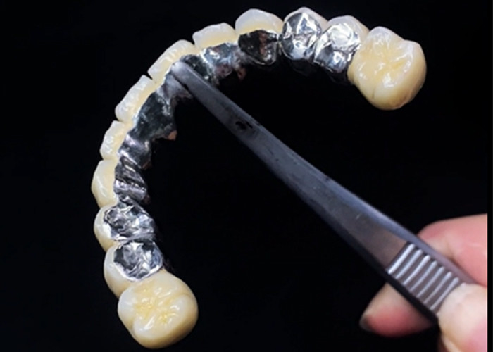 Porcelana fundida com coroa de metal que combina durabilidade e beleza para a saúde dentária