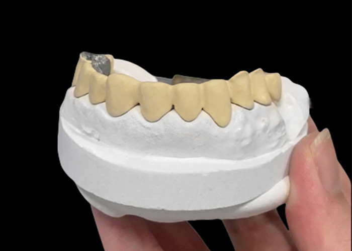 Porcelana fundida com coroa de metal que combina durabilidade e beleza para a saúde dentária