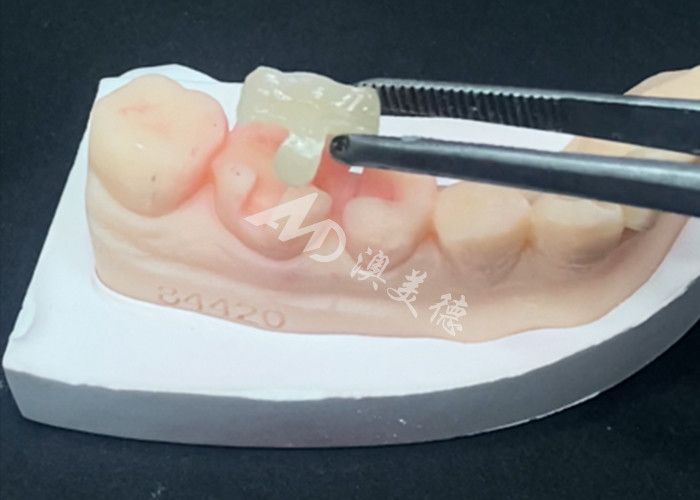 Emax Inlays Cerâmicos Onlays Restaurações Dentárias para cor natural dos dentes e fácil manutenção