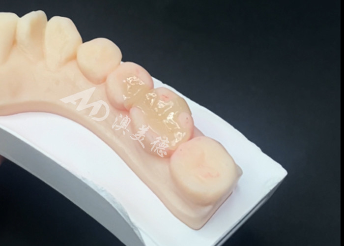 Emax Inlays Cerâmicos Onlays Restaurações Dentárias para cor natural dos dentes e fácil manutenção