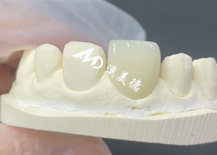 Finete EMAX Durável e Estético A Solução Perfeita para Restaurações de Porcelana