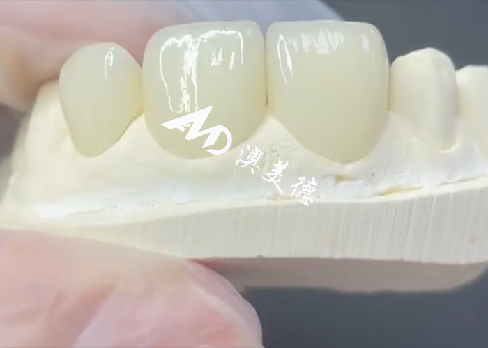 Finete EMAX Durável e Estético A Solução Perfeita para Restaurações de Porcelana