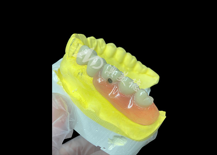 Combinação personalizada de PFM + Dentes Removíveis A solução definitiva para conforto e estética