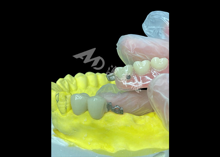 Combinação personalizada de PFM + Dentes Removíveis A solução definitiva para conforto e estética