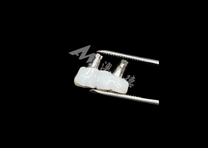 Coroas de implante dentário de zircônio com abutment de titânio para maior conforto e estética