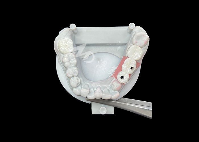 Coroas de implante dentário de zircônio com abutment de titânio para maior conforto e estética