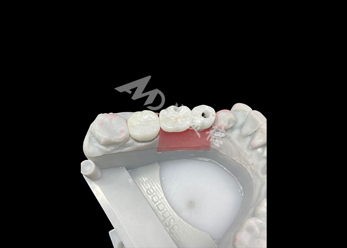 Coroas de implante dentário de zircônio com abutment de titânio para maior conforto e estética
