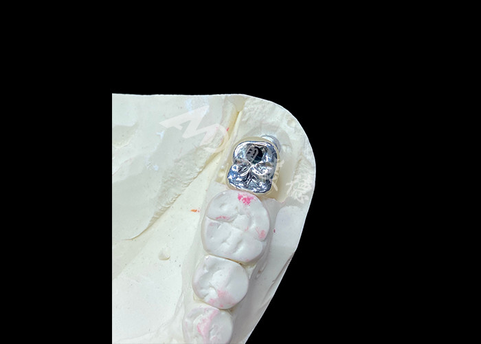 Coroa de Implantes Dentários com Abutment de Titânio e Coroa de PFM de porcelana fundida a metal