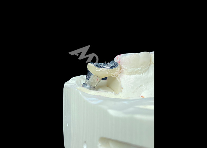 Coroa de Implantes Dentários com Abutment de Titânio e Coroa de PFM de porcelana fundida a metal
