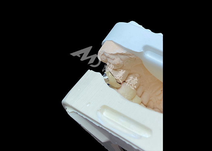 Coroa de Implantes Dentários com Abutment de Titânio e Coroa de PFM de porcelana fundida a metal