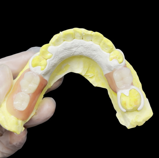 Estrutura HPP para a substituição parcial de dentes naturais