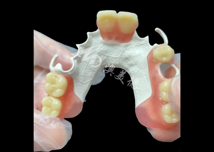 Estrutura HPP para a substituição parcial de dentes naturais