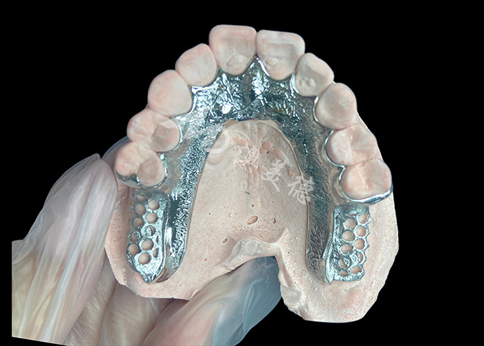 Quadro dentário de prótese dentária parcial sem dentes configurado para estabilidade e função