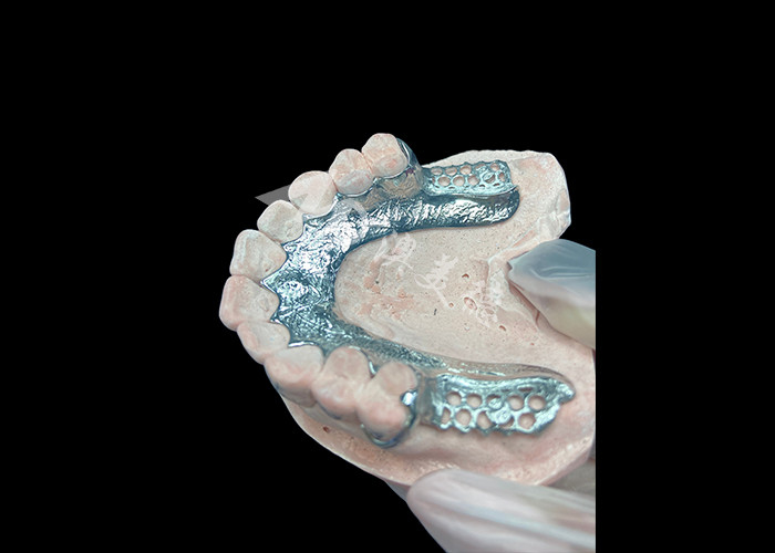 Quadro dentário de prótese dentária parcial sem dentes configurado para estabilidade e função