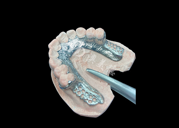 Quadro dentário de prótese dentária parcial sem dentes configurado para estabilidade e função