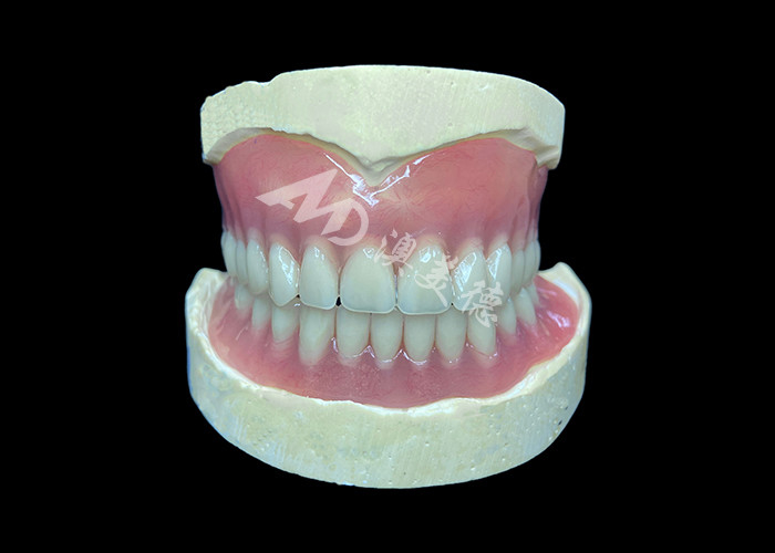 Dentes parciais de fundição personalizada, fáceis de limpar, ideais para restaurar a capacidade de mastigar e sorrisos