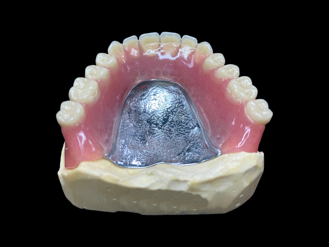 Dentes parciais de fundição personalizada, fáceis de limpar, ideais para restaurar a capacidade de mastigar e sorrisos