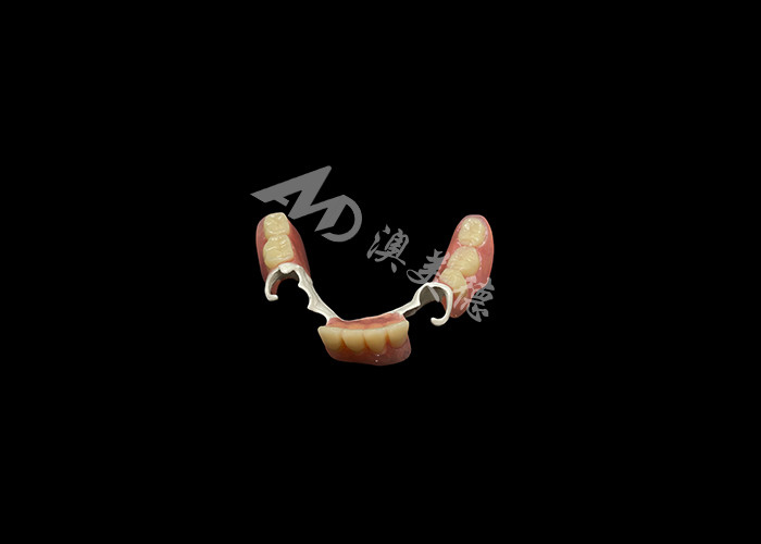 Dentes parciais de fundição duráveis feitos sob medida com estrutura HPP para restaurar o seu sorriso