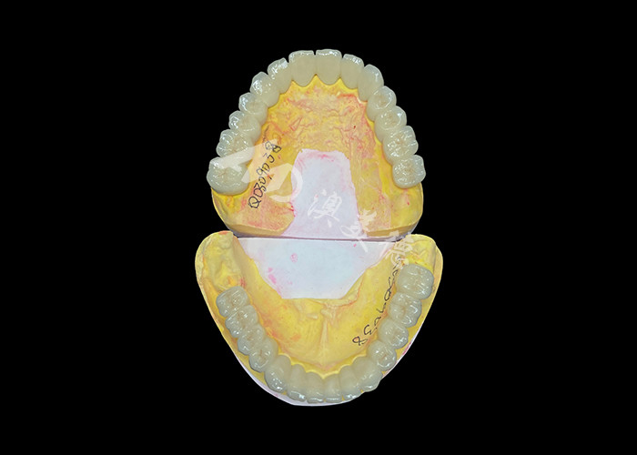 Porcelana personalizada fundida a ponte de coroa dental de metal para melhorar o sorriso natural