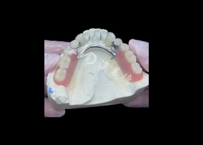 Porcelana durável fundida a metal coroa dental PFM coroa para restauração
