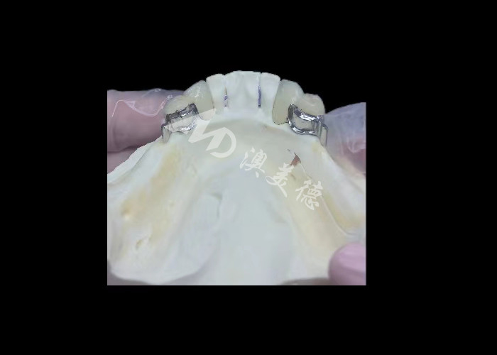 Porcelana durável fundida a metal coroa dental PFM coroa para restauração
