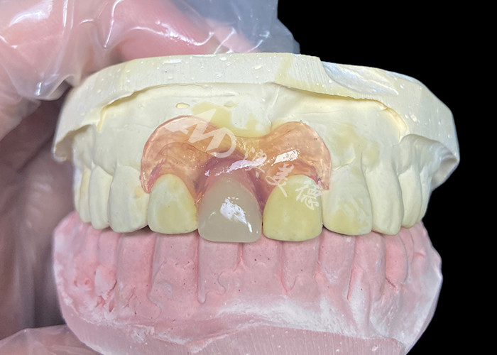 Próteses parciais flexíveis Nesbit para incisivos que oferecem uma solução de substituição de dente removível sem costura