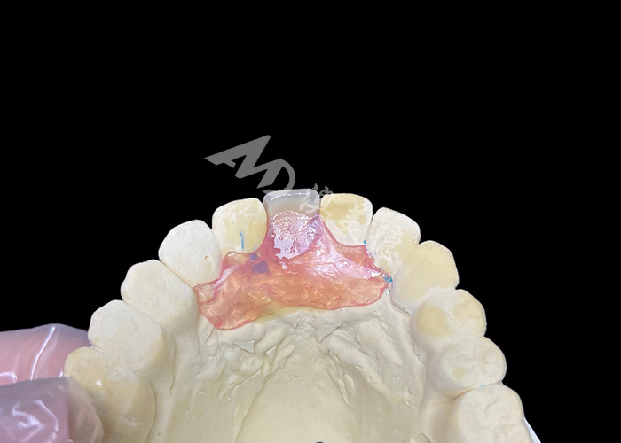 Próteses parciais flexíveis Nesbit para incisivos que oferecem uma solução de substituição de dente removível sem costura