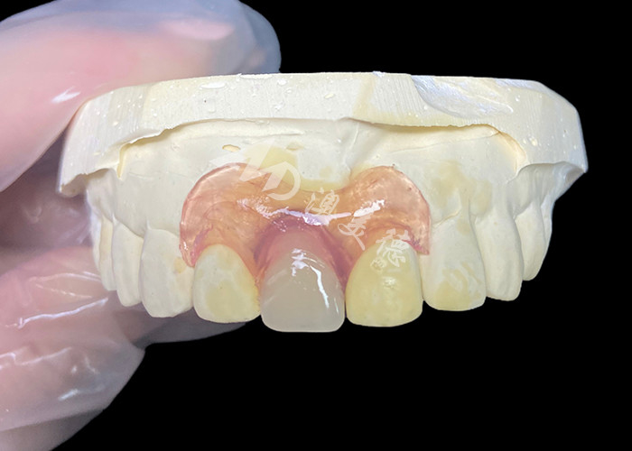 Próteses parciais flexíveis Nesbit para incisivos que oferecem uma solução de substituição de dente removível sem costura