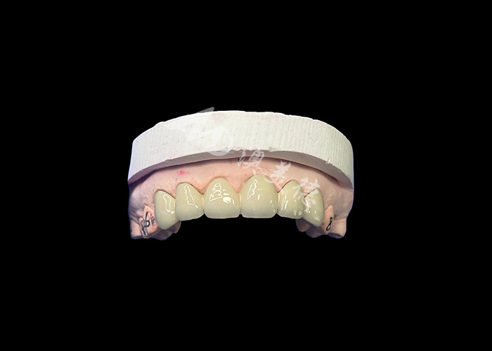 Porcelana biocompativel fundida com coroa de metal de alta durabilidade para melhor restauração