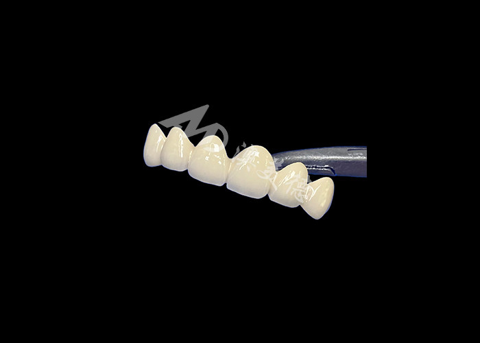 Porcelana biocompativel fundida com coroa de metal de alta durabilidade para melhor restauração