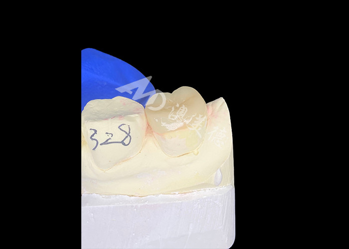 IPS E.max Inlays Cerâmicos Inlays Onlays Mistura sem costura de aparência natural e durável com os dentes