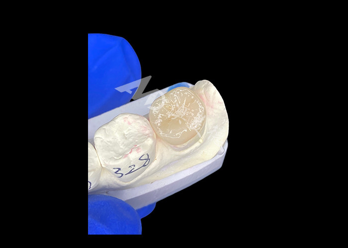 IPS E.max Inlays Cerâmicos Inlays Onlays Mistura sem costura de aparência natural e durável com os dentes