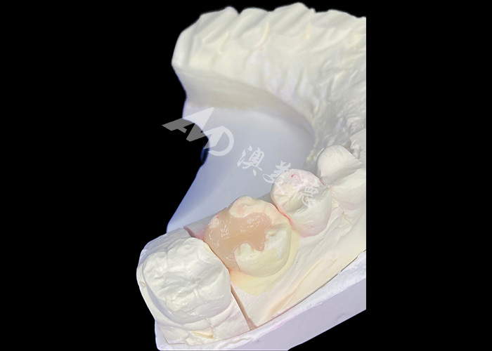 IPS e.max Inlays e Onlays cerâmicos para restauração molar com resultados estéticos e naturais duradouros