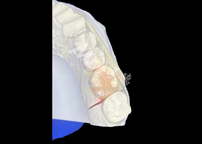 IPS e.max Inlays e Onlays cerâmicos para restauração molar com resultados estéticos e naturais duradouros