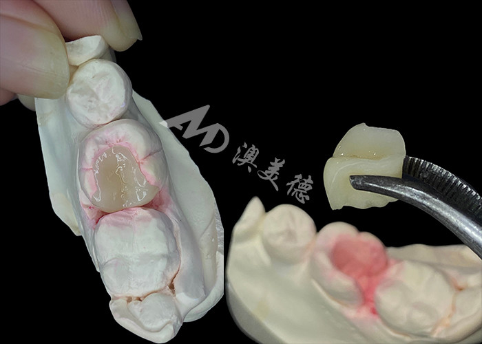 IPS e.max Inlays e Onlays cerâmicos para restauração dental de aparência natural