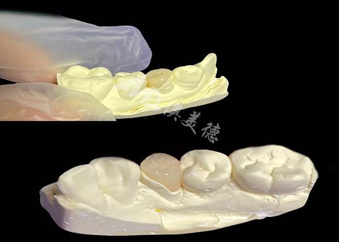 IPS e.max Inlays e Onlays cerâmicos para restauração dental de aparência natural