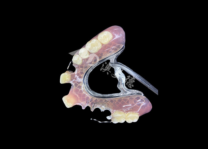 Dentes parciais fundidos adaptáveis para durabilidade e conforto de precisão na substituição parcial de dentes
