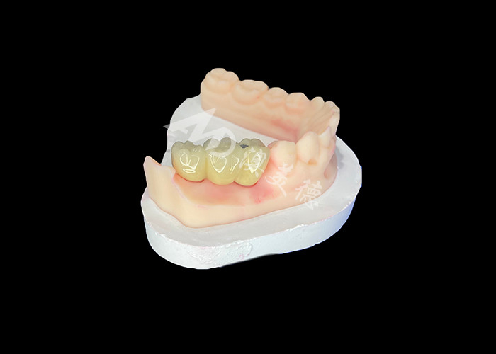 PFM coroas dentárias realistas e resistentes à corrosão para uma saúde oral ideal