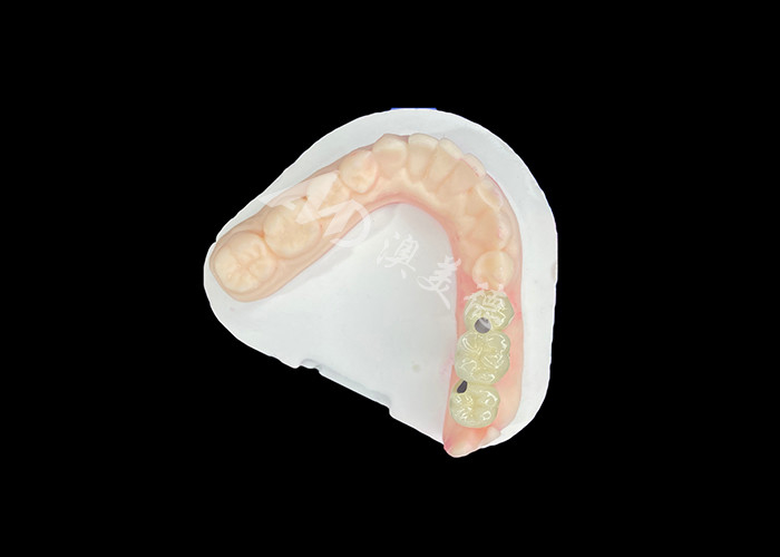 PFM coroas dentárias realistas e resistentes à corrosão para uma saúde oral ideal