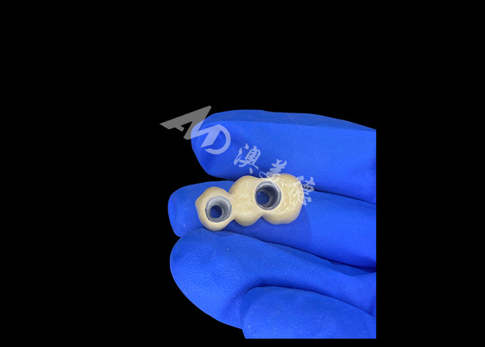 PFM coroas dentárias realistas e resistentes à corrosão para uma saúde oral ideal